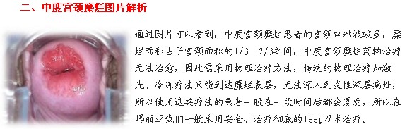 宫颈糜烂图片是什么样 宝鸡妇科给你介绍