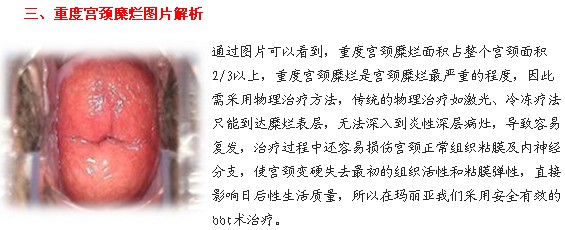 宫颈糜烂图片是什么样 宝鸡妇科给你介绍